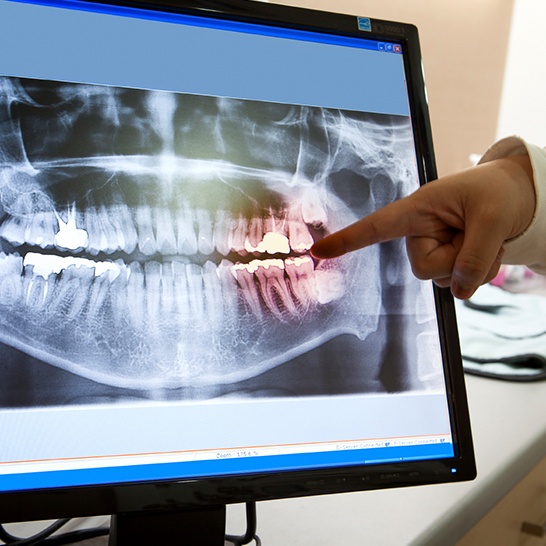 Panoramic digital x-rays