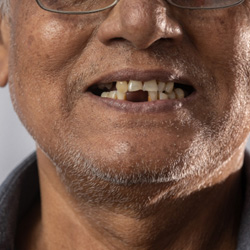 Man with multiple missing 