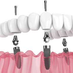 Digital image of implant denture 