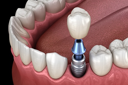 Animated dental implant supported dental crown placement