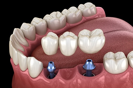 Animated dental implant supported fixed bridge placement