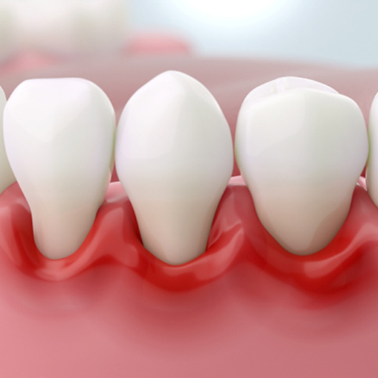 Illustration of red, inflamed gums