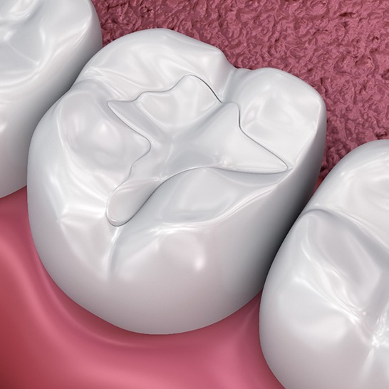Render of tooth-colored fillings in Mission Viejo, CA