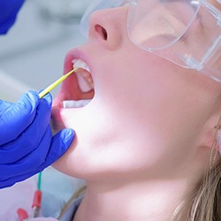 Gloved hand applying fluoride gel to woman’s teeth