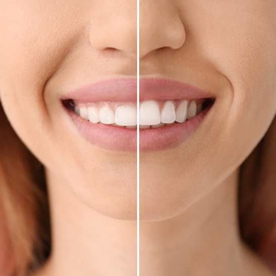 Close-up of woman’s smile before and after gum recontouring