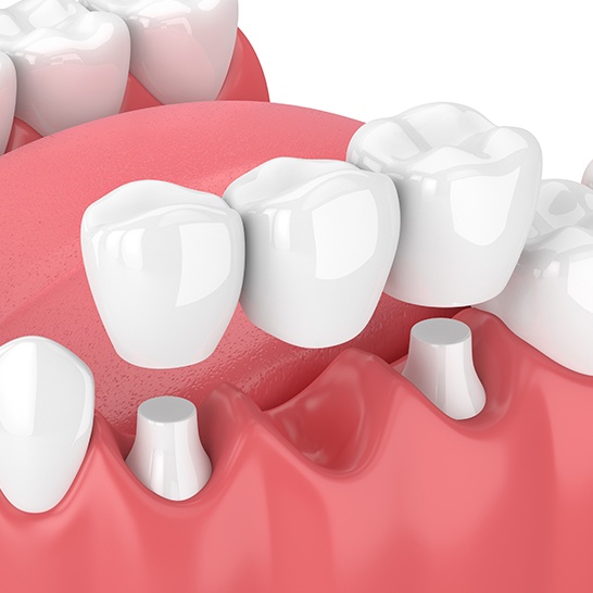 Animated dental bridge placement