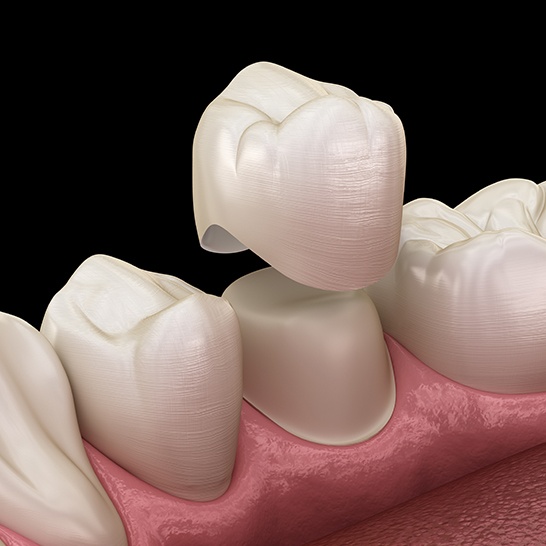 Animated metal free dental crown placement