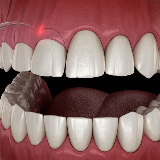 Animated smile during gum recontouring treatment