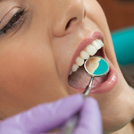 Dentist checking patient's tooth colored fillings