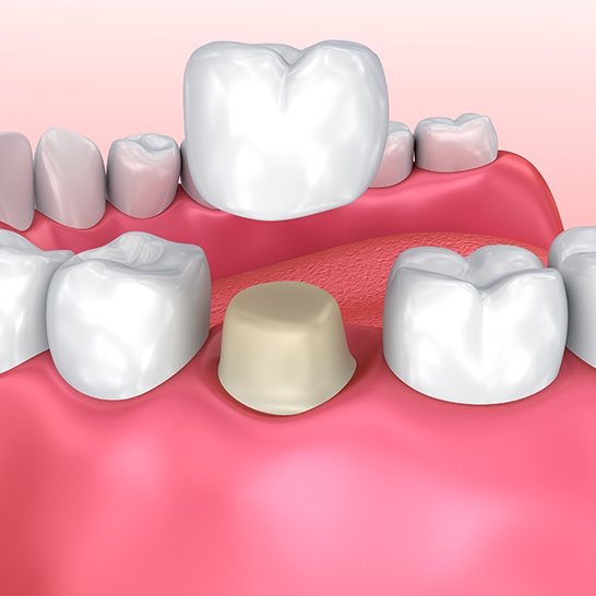 Animated dental crown placement