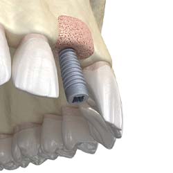 Digital illustration of bone graft for dental implant in Mission Viejo