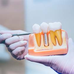 Dentist pointing to dental implant in Mission Viejo
