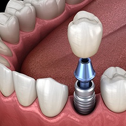 Animated dental implant supported dental crown placement
