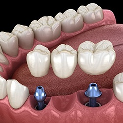 Animated dental implant supported fixed bridge placement