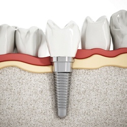 3D illustration of a dental implant, abutment, and crown with rest of smile