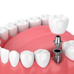 3D illustration of a dental implant, abutment, and crown with smile