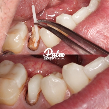 Dentist and male patient giving thumbs up in dental treatment room in Mission Viejo