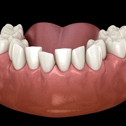 Digital illustration of crowded teeth in Mission Viejo before Invisalign