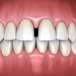 Digital illustration of gap between front teeth in Mission Viejo