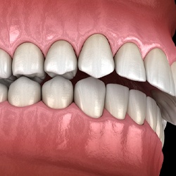 Digital illustration of overbite in Mission Viejo before Invisalign