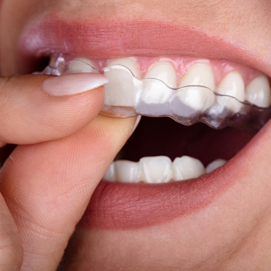 closeup of woman inserting Invisalign in Mission Viejo 