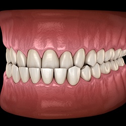 Illustration of an underbite