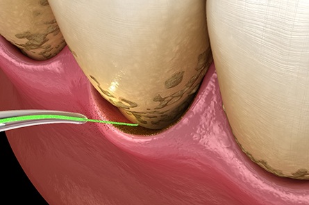 Laser gum disease treatment