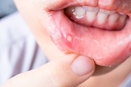 Canker sore