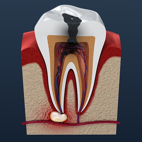 Animated tooth in need of root canal therapy