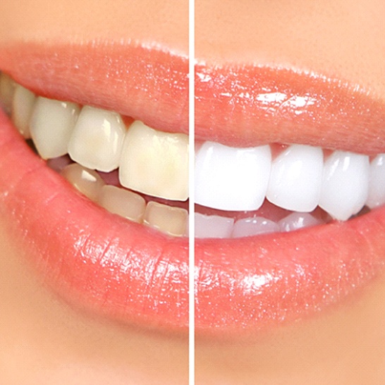 Closeup of comparison of teeth whitening in Mission Viejo