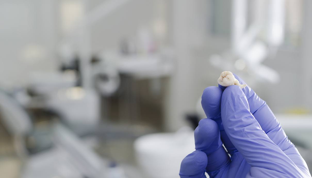 Hand holding an extracted tooth