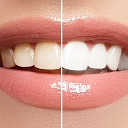 an example of discolored and whitened teeth