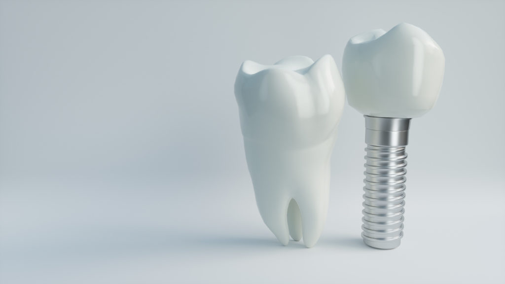 Model of a dental implant next to a natural tooth