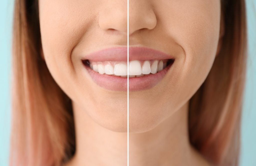 Before and after of gum recontouring