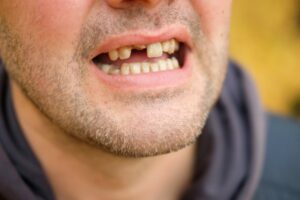 Man with missing teeth. 